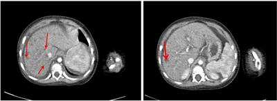 Liver transplantation for mitochondrial DNA depletion syndrome caused by MPV17 deficiency: a case report and literature review